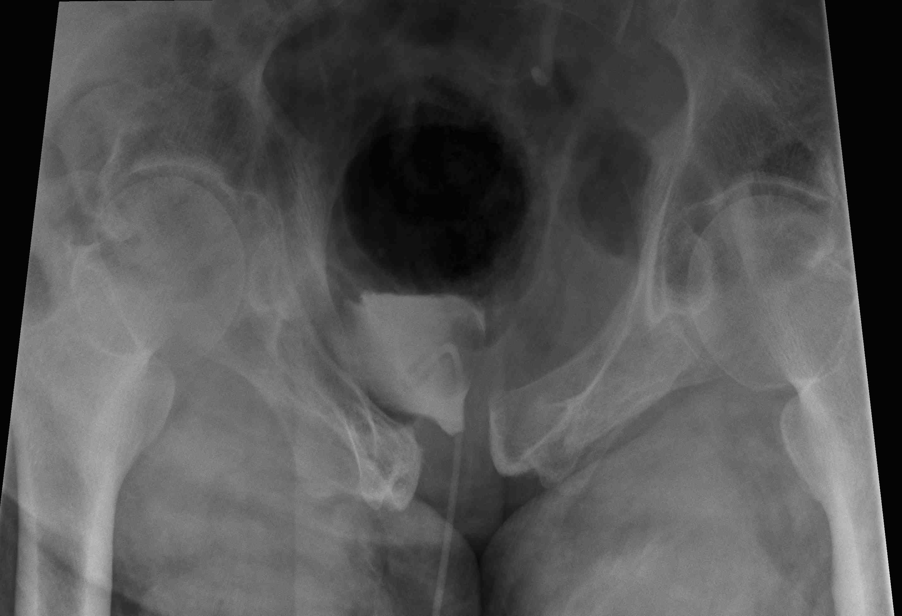 Pelvic Fracture Retrograde Urethrogram Normal